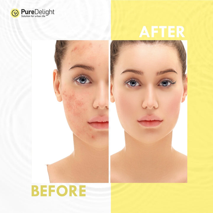 Pure Delight Vitamin C 20% Serum + Anti-Acne Foaming Facewash Brightening & Clear Skin Duo  Description:
